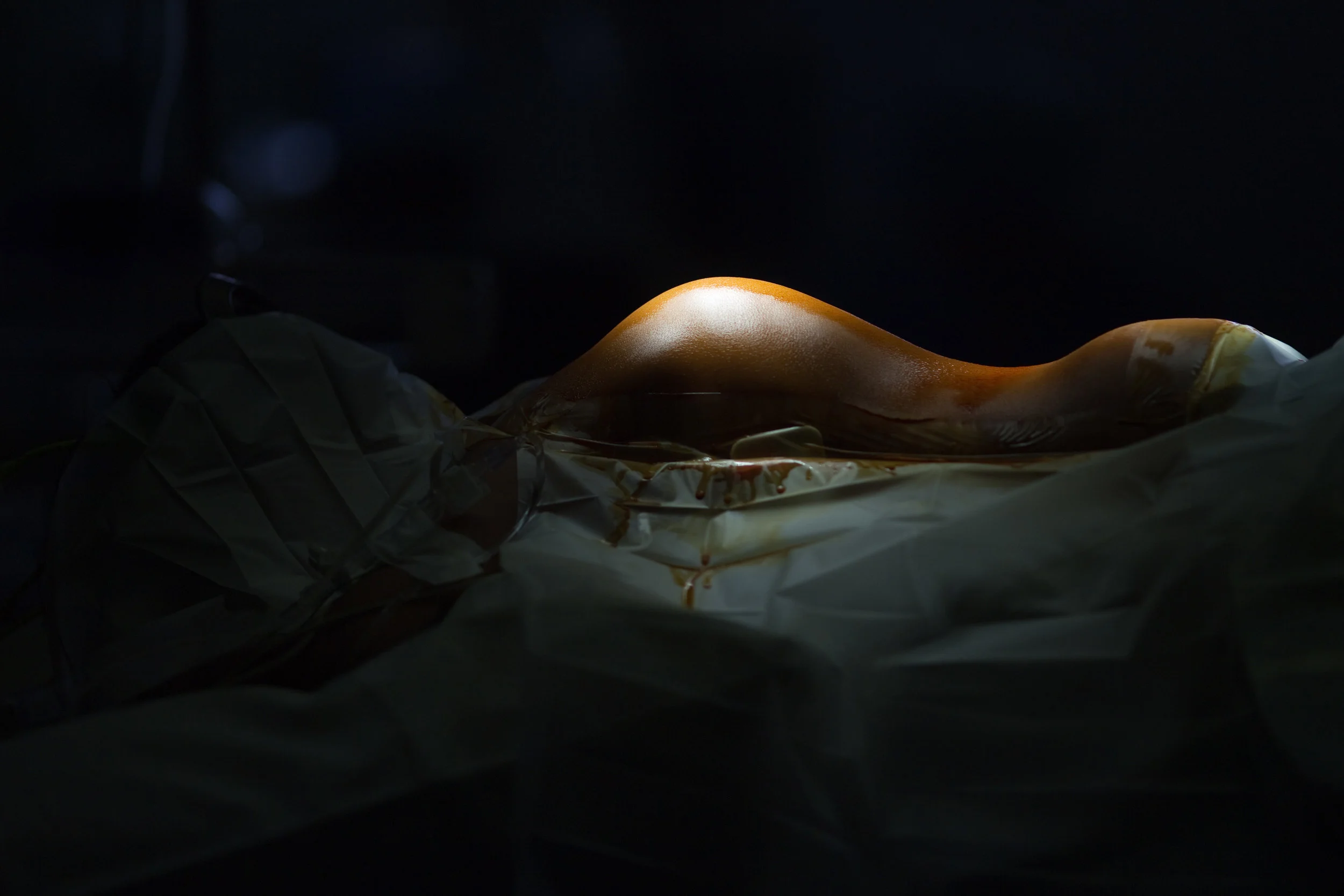  Sisay's back under lights just before surgery, where Boachie-Adjei and his team inserted screws into many of Sisay's vertebrae and attached growing rods to his spine to help straighten and lengthen it in Accra, Ghana. 