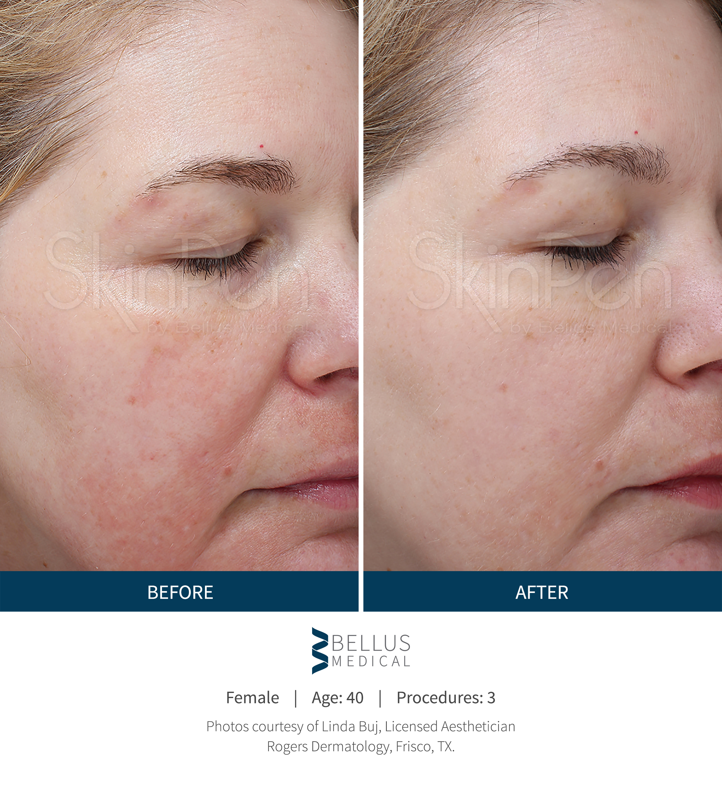 SkinPen slide1 improved skin quality.jpg