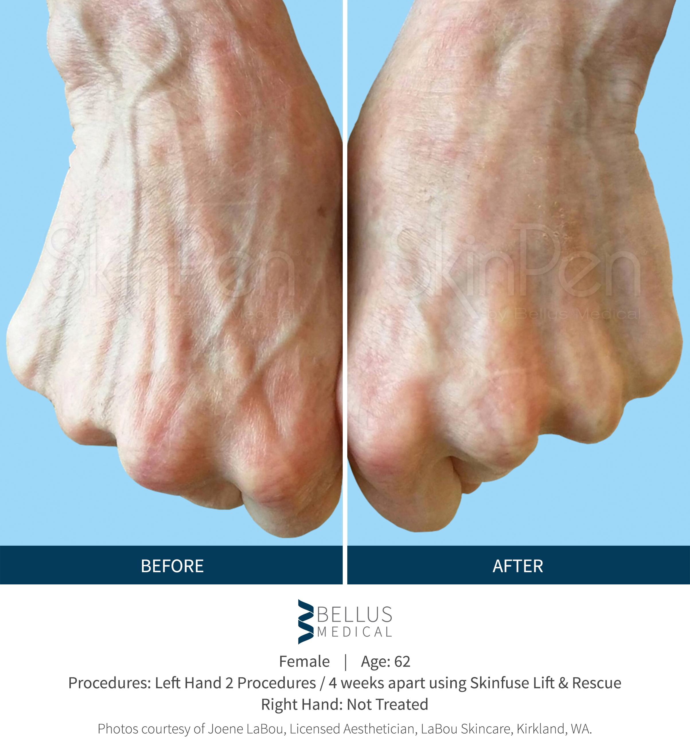 SkinPen slide5 improved hands.jpg
