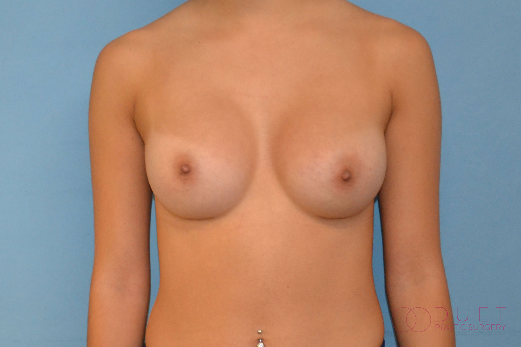 breast-augmentation-post-1-watermarked.jpg