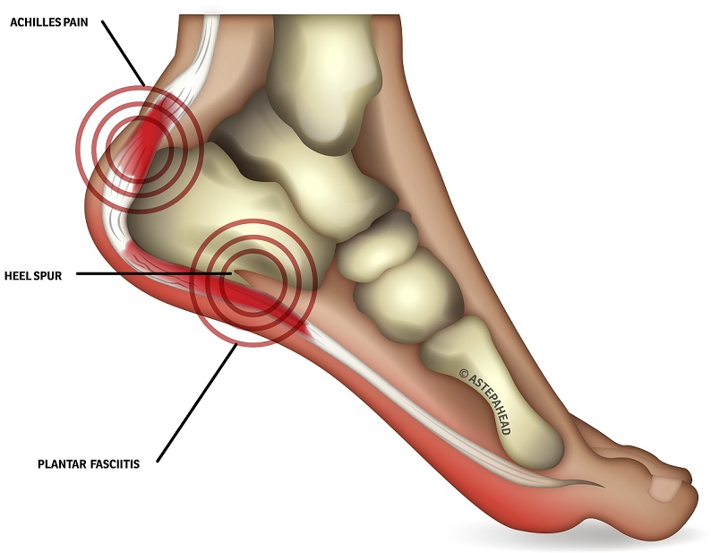 sore heel and foot