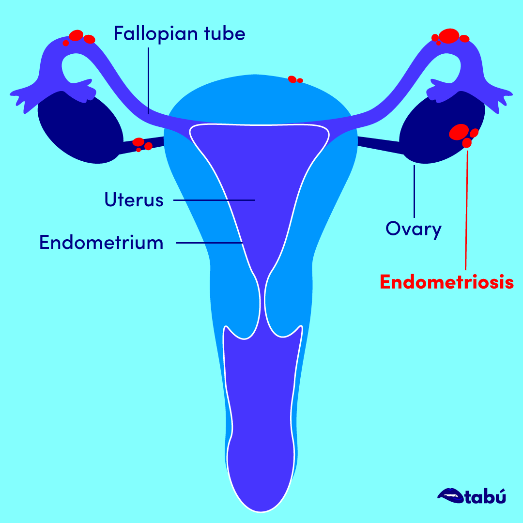 Endometriosis Illustration