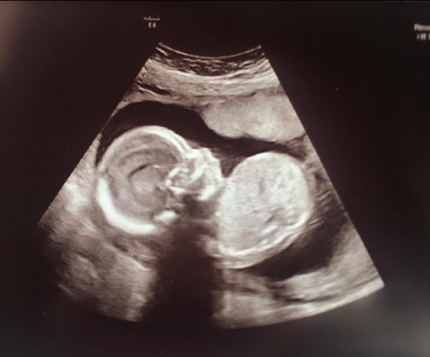 20 Weeks