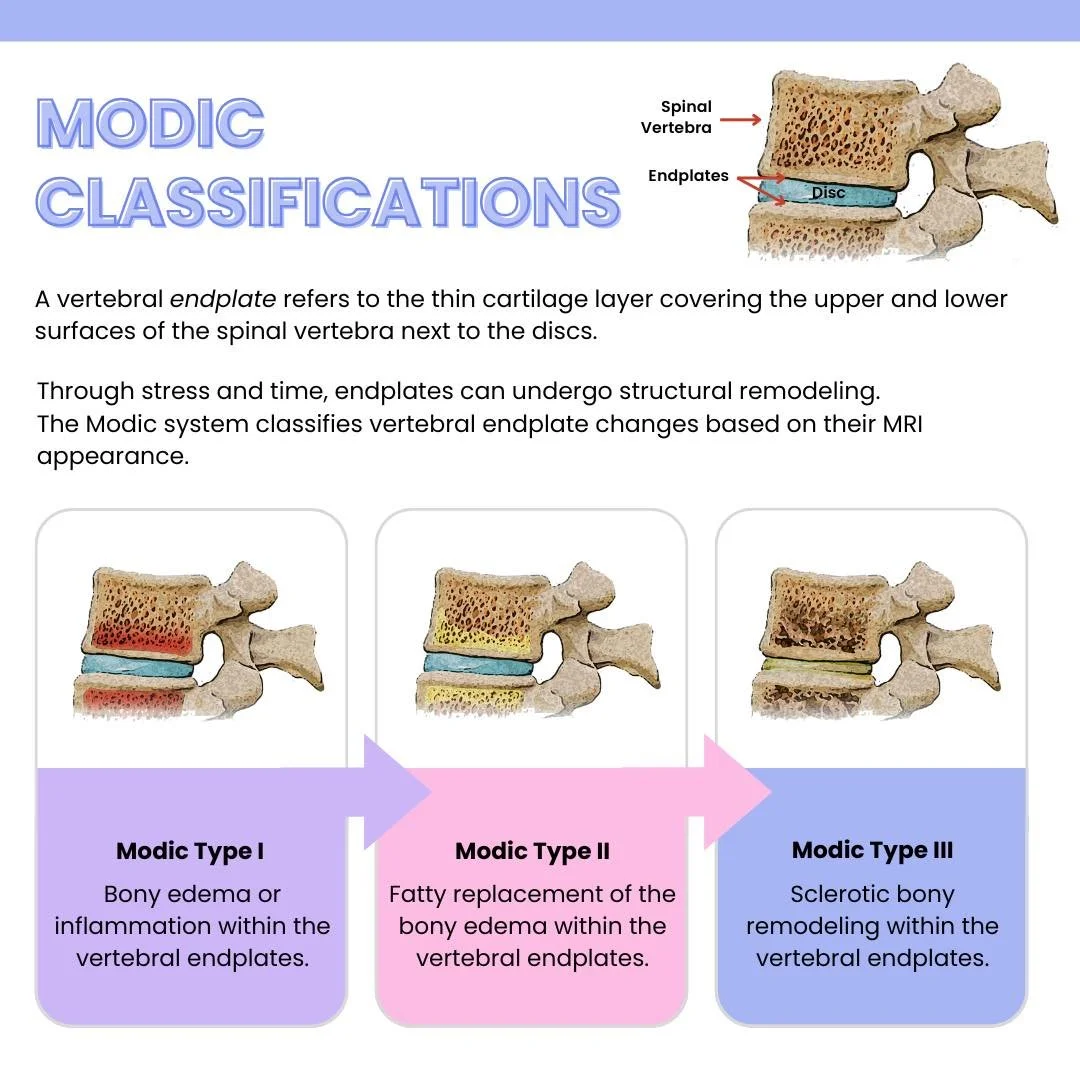 Ever seen &ldquo;Modic changes&rdquo; on an MRI and wondered what it means? 🧠🩻

Modic changes are alterations in the bones and are fairly common in people with back pain. Some types, such as Type I, can be associated with greater discomfort.

But h