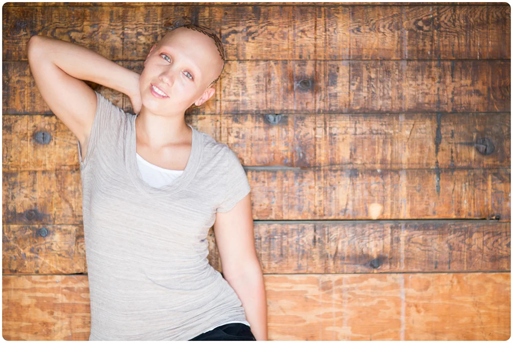 O que é alopécia? Como lidar com ela ? 