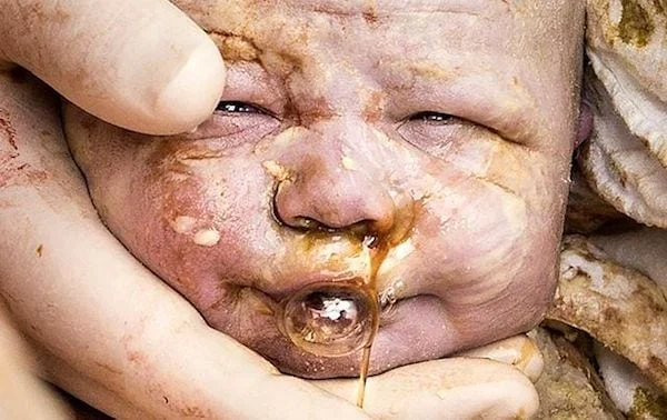sindrome-aspiracion-meconio-sam.jpg