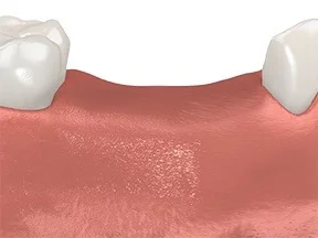 multiple tooth missing teeth.png