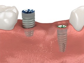multiple tooth missing teeth with implants copy.png