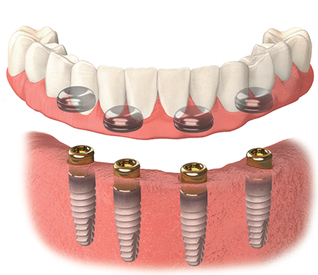 seating denture.png