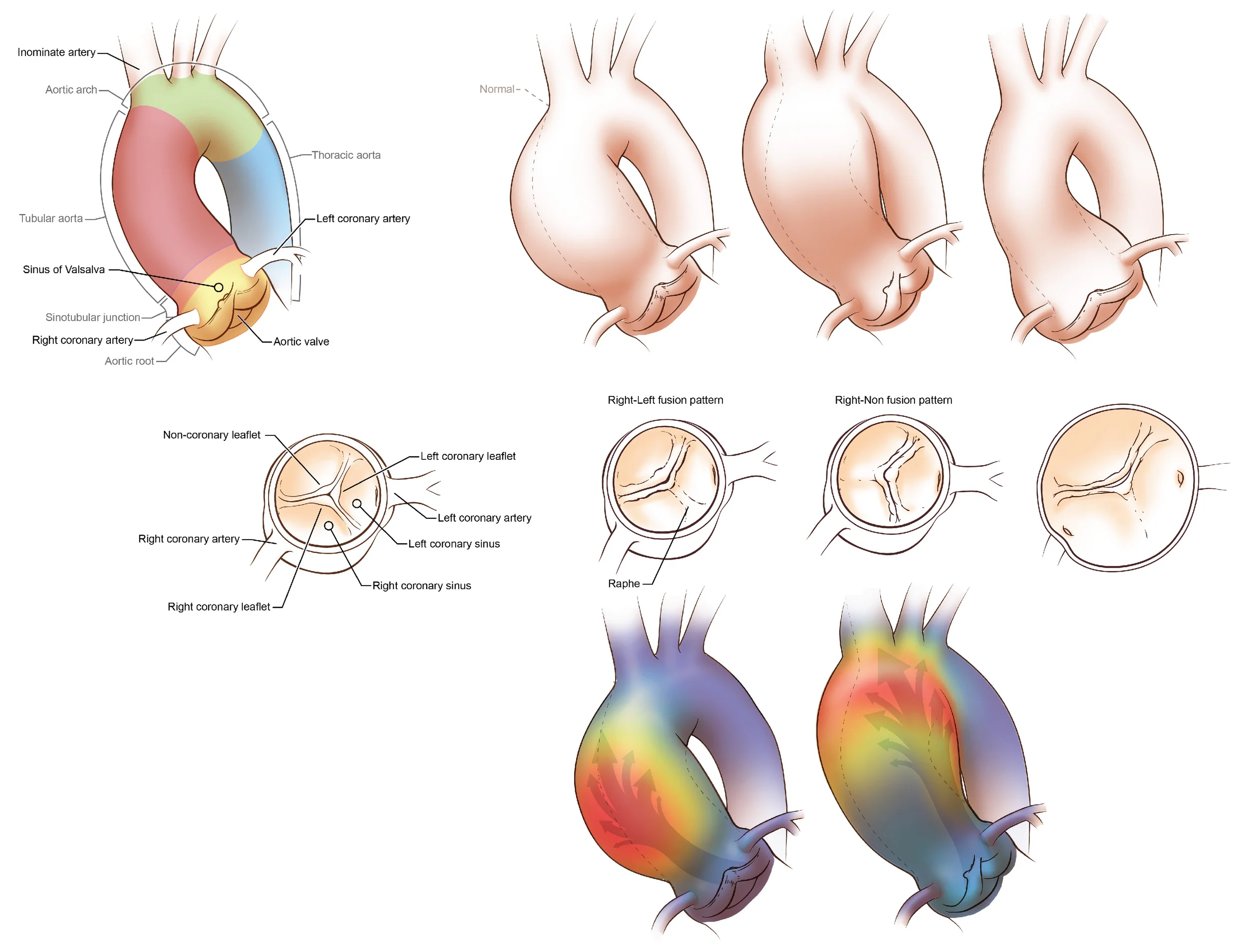 Bicuspid Aortic Valves