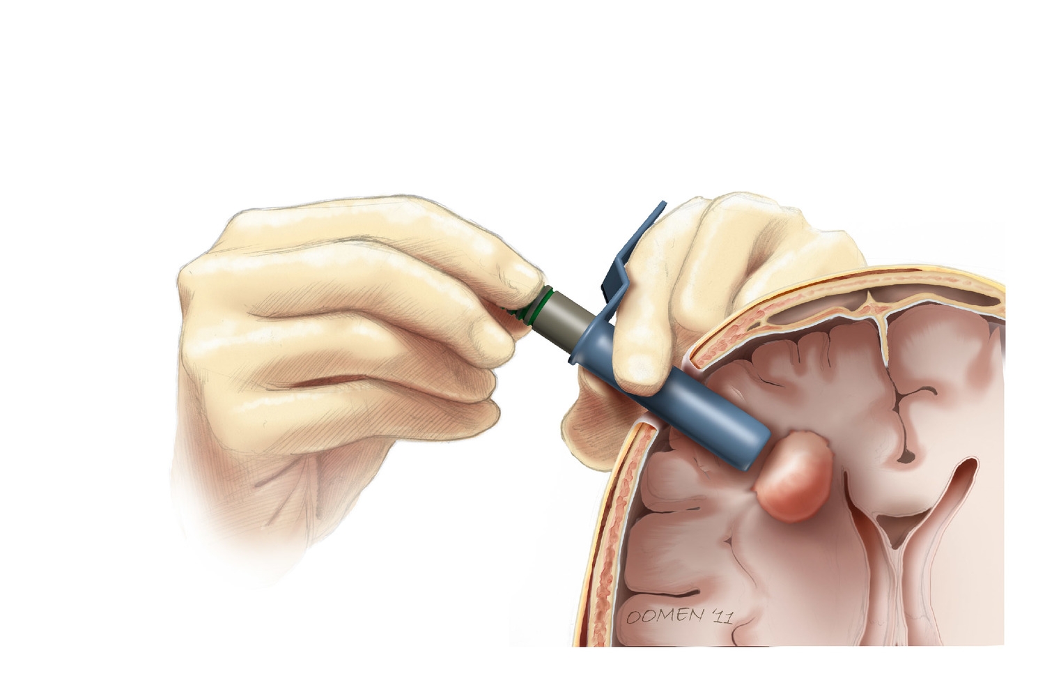 Tube Retractors