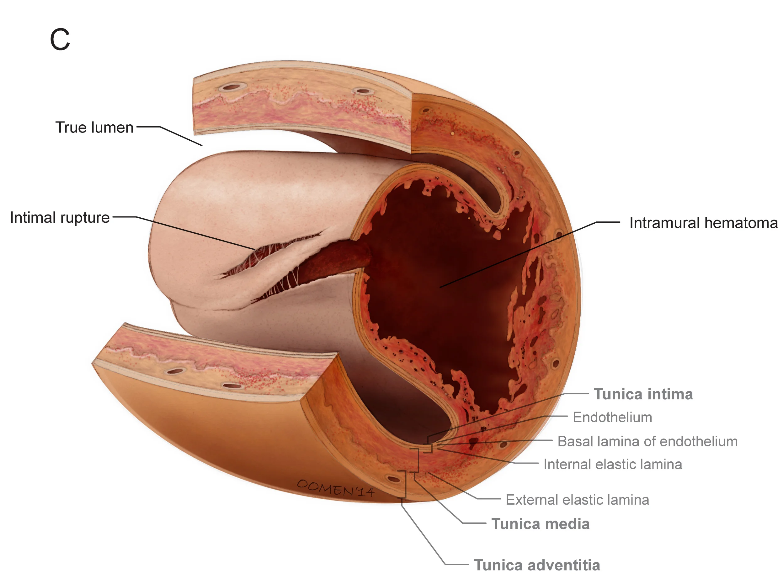 Image copyright 2014, Glen Oomen &amp; Dr. Jacqueline Saw, Vancouver General Hospital / University of British Columbia