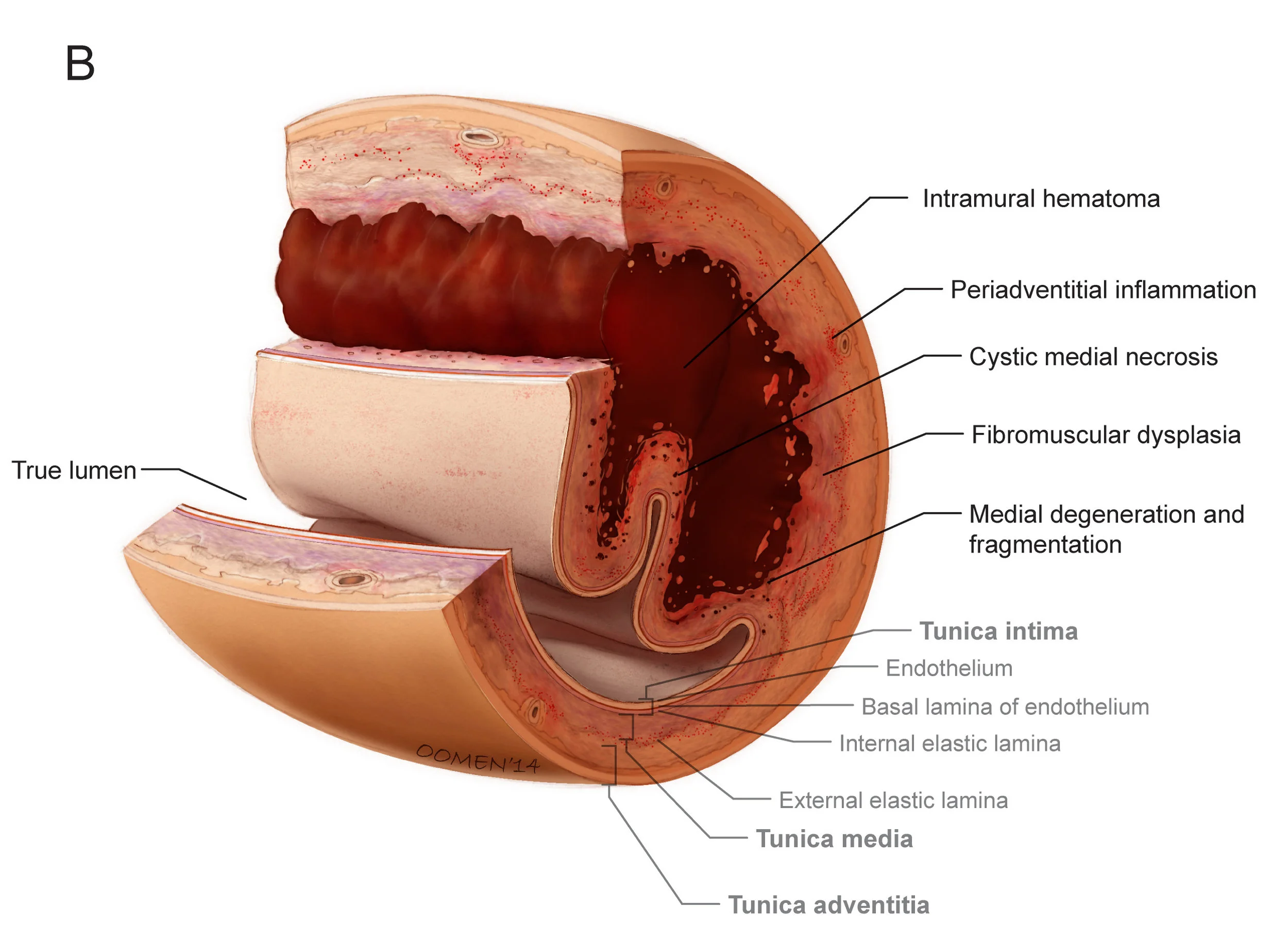 Image copyright 2014, Glen Oomen &amp; Dr. Jacqueline Saw, Vancouver General Hospital / University of British Columbia