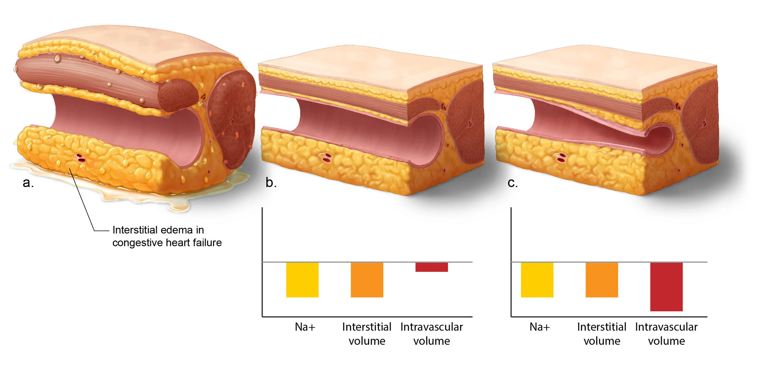 Ah, the old block-of-human-tissue trick for illustrating pathology. In this case I was showing the oedema in generic tissue caused by diabetic heart failure, and the resulting changes resulting from administrating tube diuretics or SGLT2 inhibitors.…