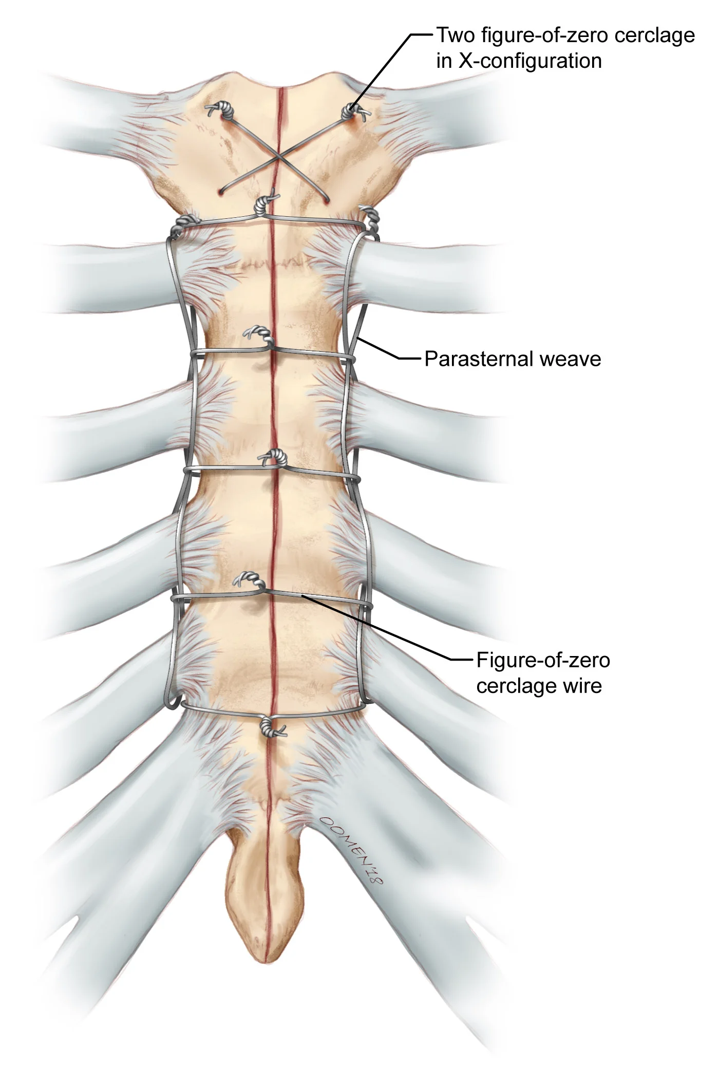 Who knew sternum nonfusion was a problem? — Glen Oomen Illustration
