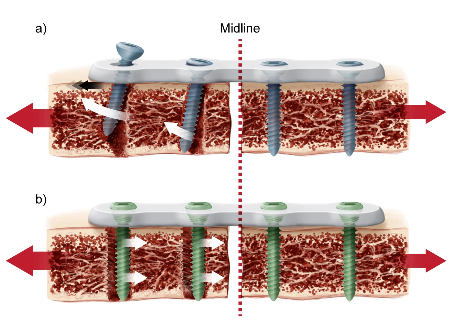 Non-locking vs Locking screw/plate tear out patterns. Copyright 2018 Oomen/Gandhi