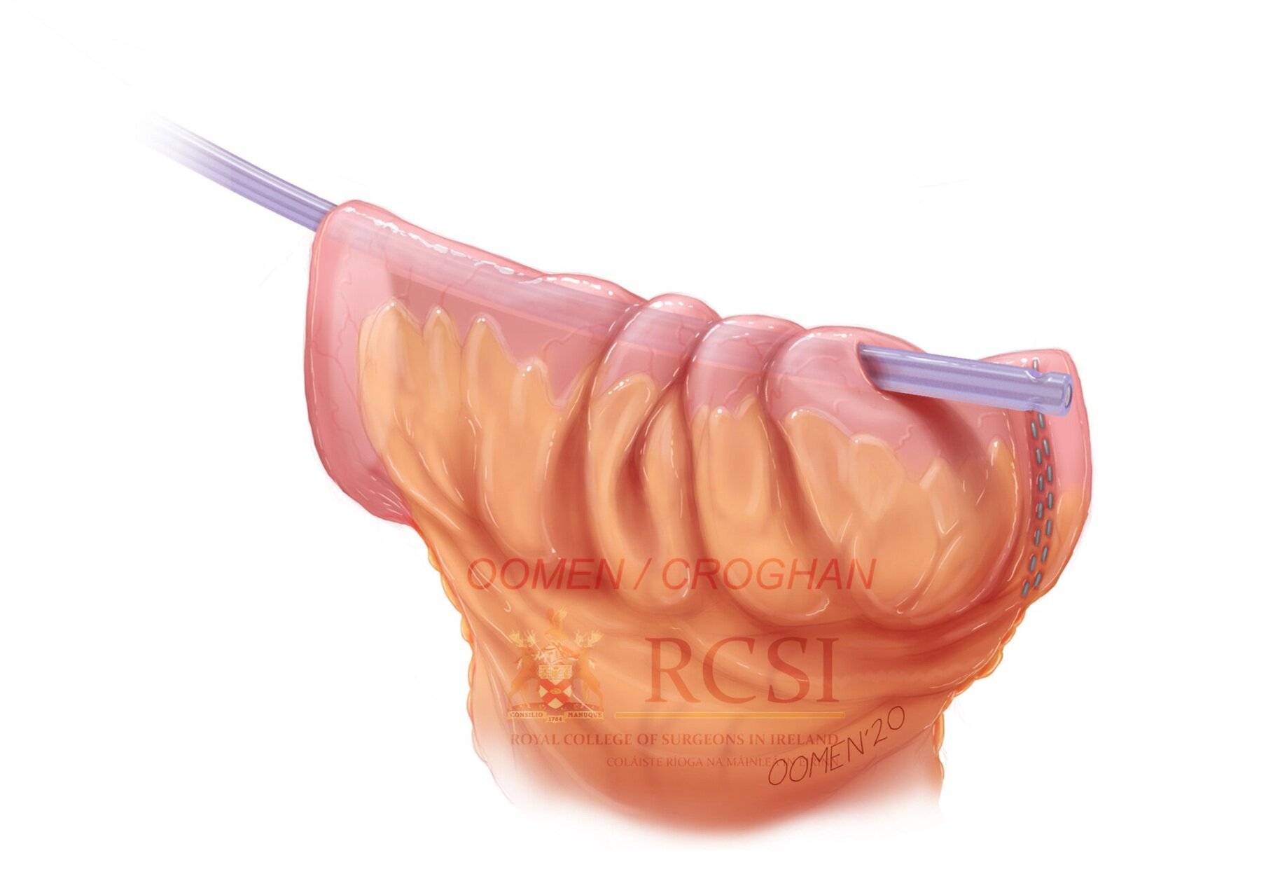 A Yankauer suction tube is pushed through a perforation in the bowel to use as a guide for a catheter and guidewire.