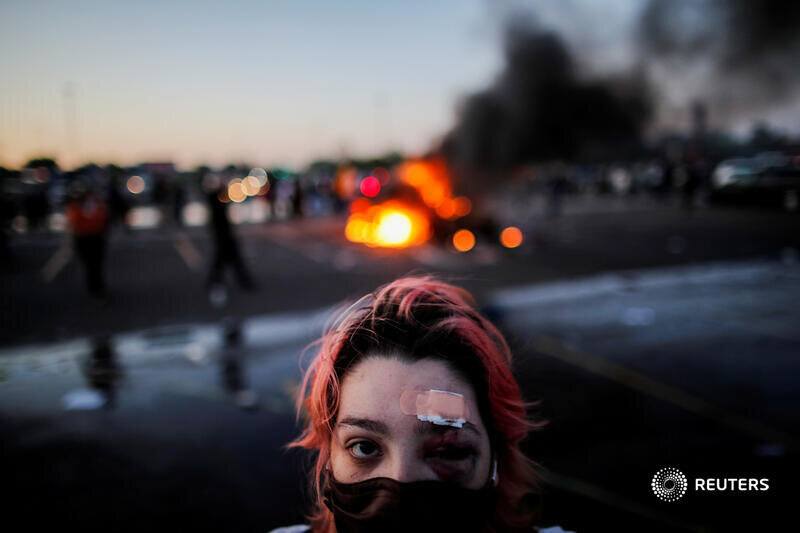  Rachel Perez is pictured with bruising around her eye and a plaster on her forehead, injuries sustained from rubber bullets during protests yesterday, while standing a distance from a burning vehicle at the parking lot of a Target store as demonstra