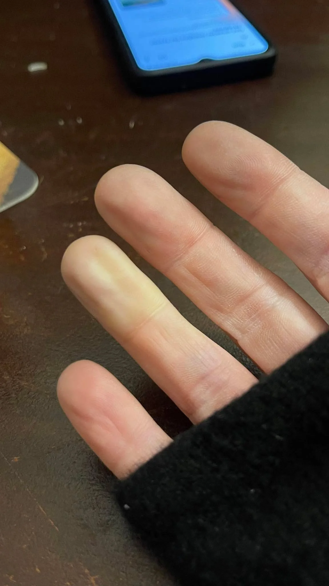 Hello Raynauds my old friend&hellip;&hellip;.. 😫