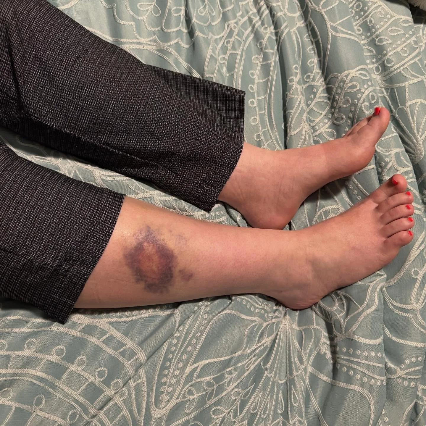 Funny story. During the storms Friday night, I sprinted from our van to get inside, holding my daughter&rsquo;s hand like my life depended on it.  At some point in my heroic escape, I apparently slammed my leg into my own car door. I didn&rsquo;t thi