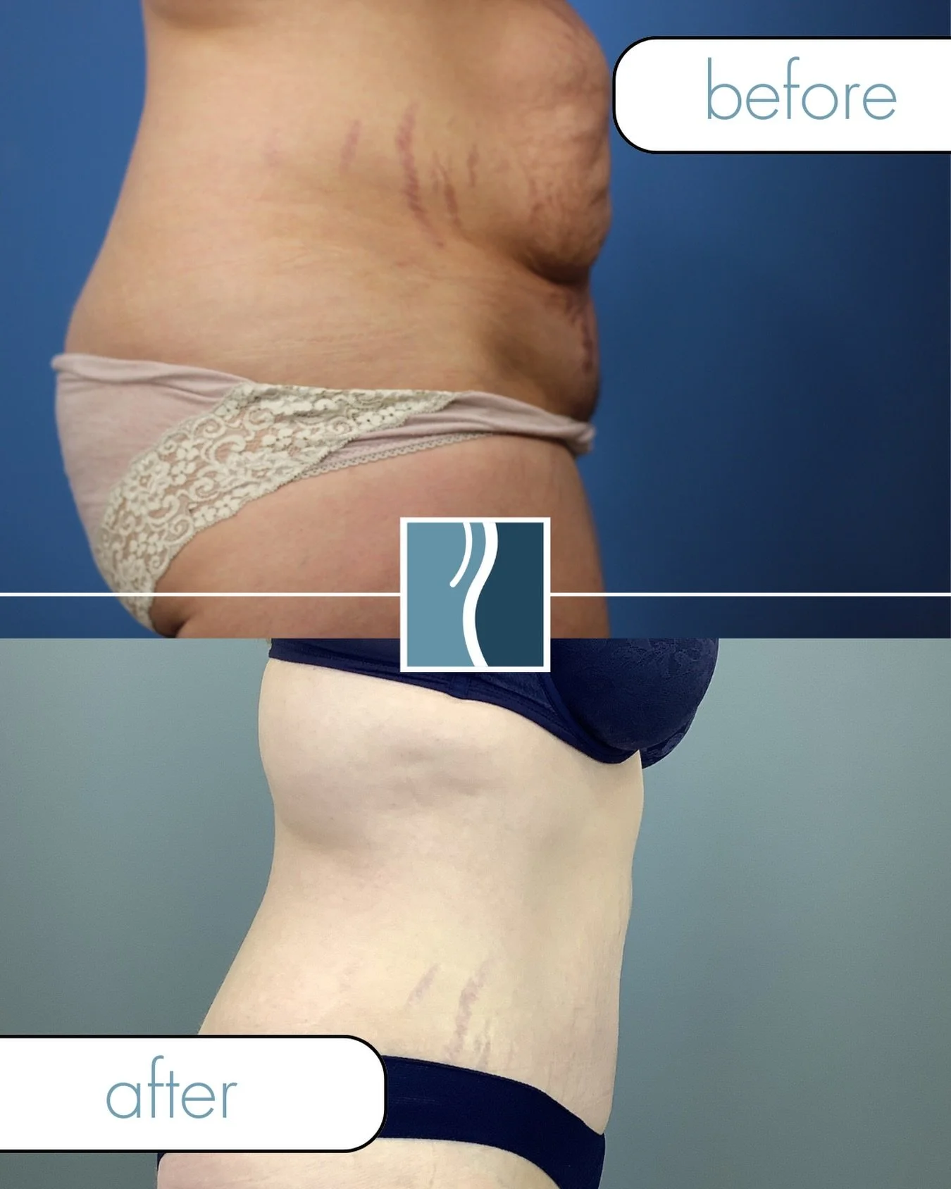 Let&rsquo;s talk about tummy tucks! 🗣️ Sometimes, diet and exercise just can&rsquo;t get rid of stubborn skin or muscle separation. Dr. Luong combines technical expertise with an artistic eye to give you a natural, beautiful contour. Consult with us