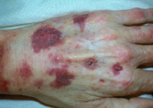 Scurvy Hand
