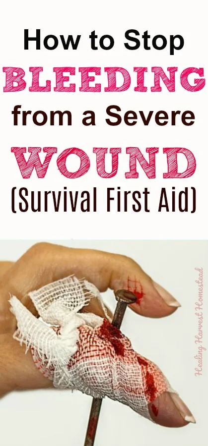 Survival Tip: How to stop bleeding from a severe wound. Put these basic first aid practices into action if you heed help stopping bleeding. Gunshots, punctures, scrapes, knife slices, and more, along with essential basic procedures to follow for shock. #wound #stopbleeding #care #gunshot #punctures #scrapes #cuts #knifewound #basic #firstaid #survival #skill