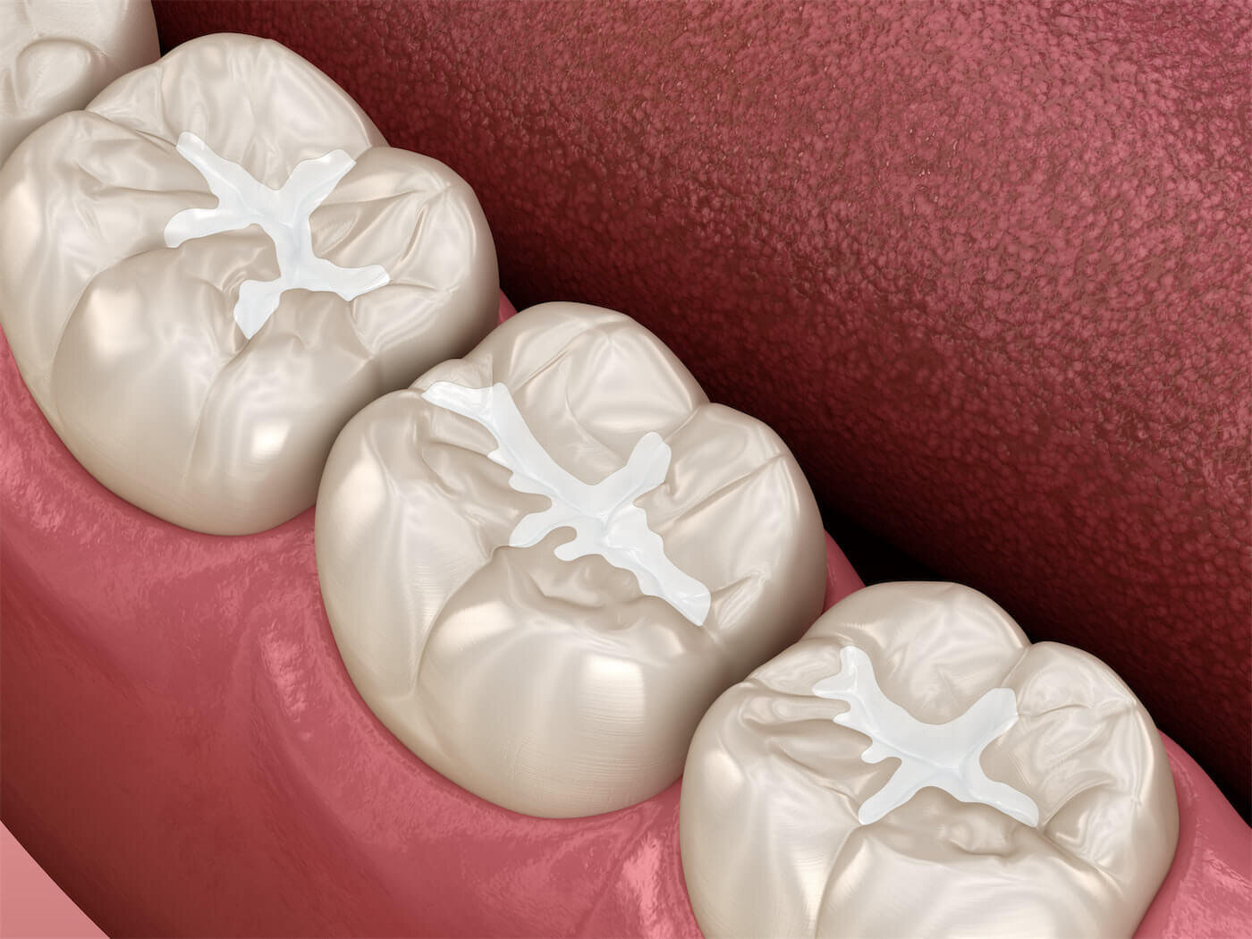 What is a Filling? Understanding Dental Restorations