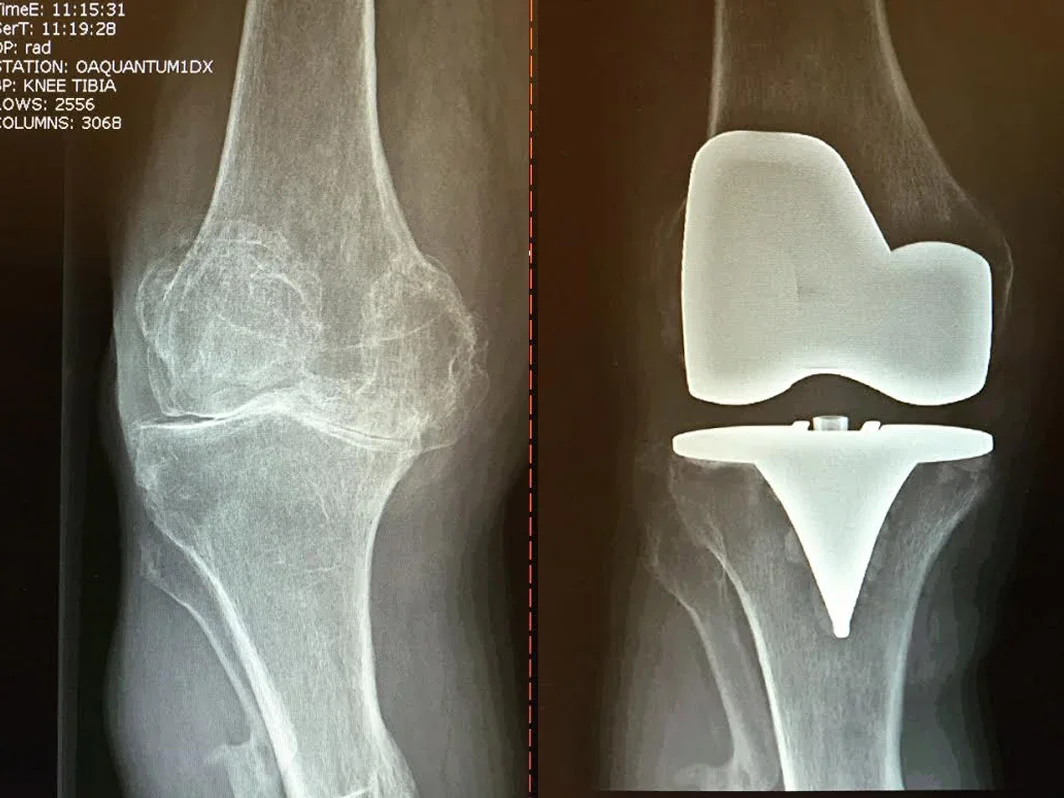 xray-knee.jpg