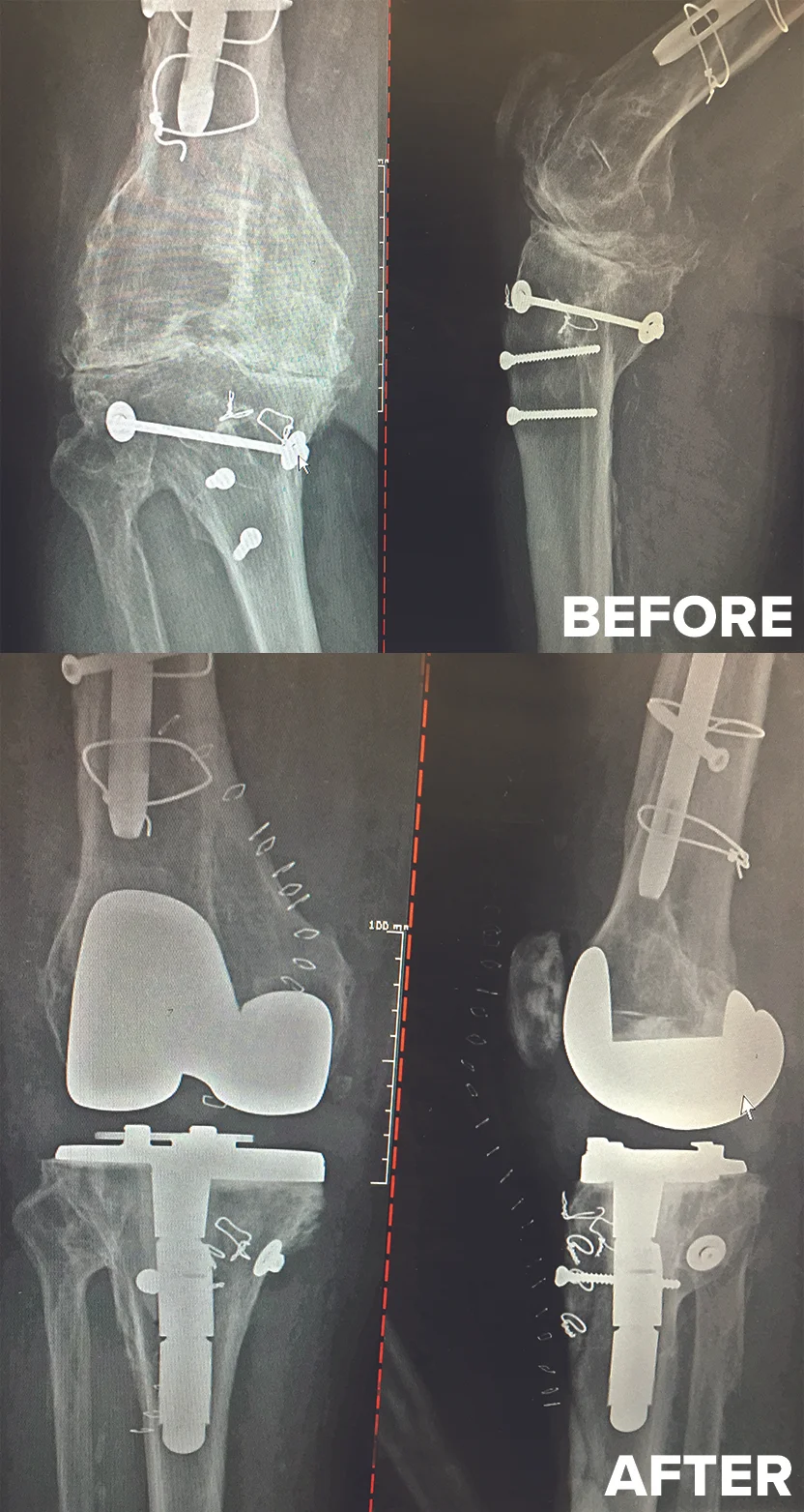 Before: Post traumatic knee arthritis with retained screws, rod, wires and deformityAfter: Complex Total Knee Replacement - leg now straightBIOMET REVISION