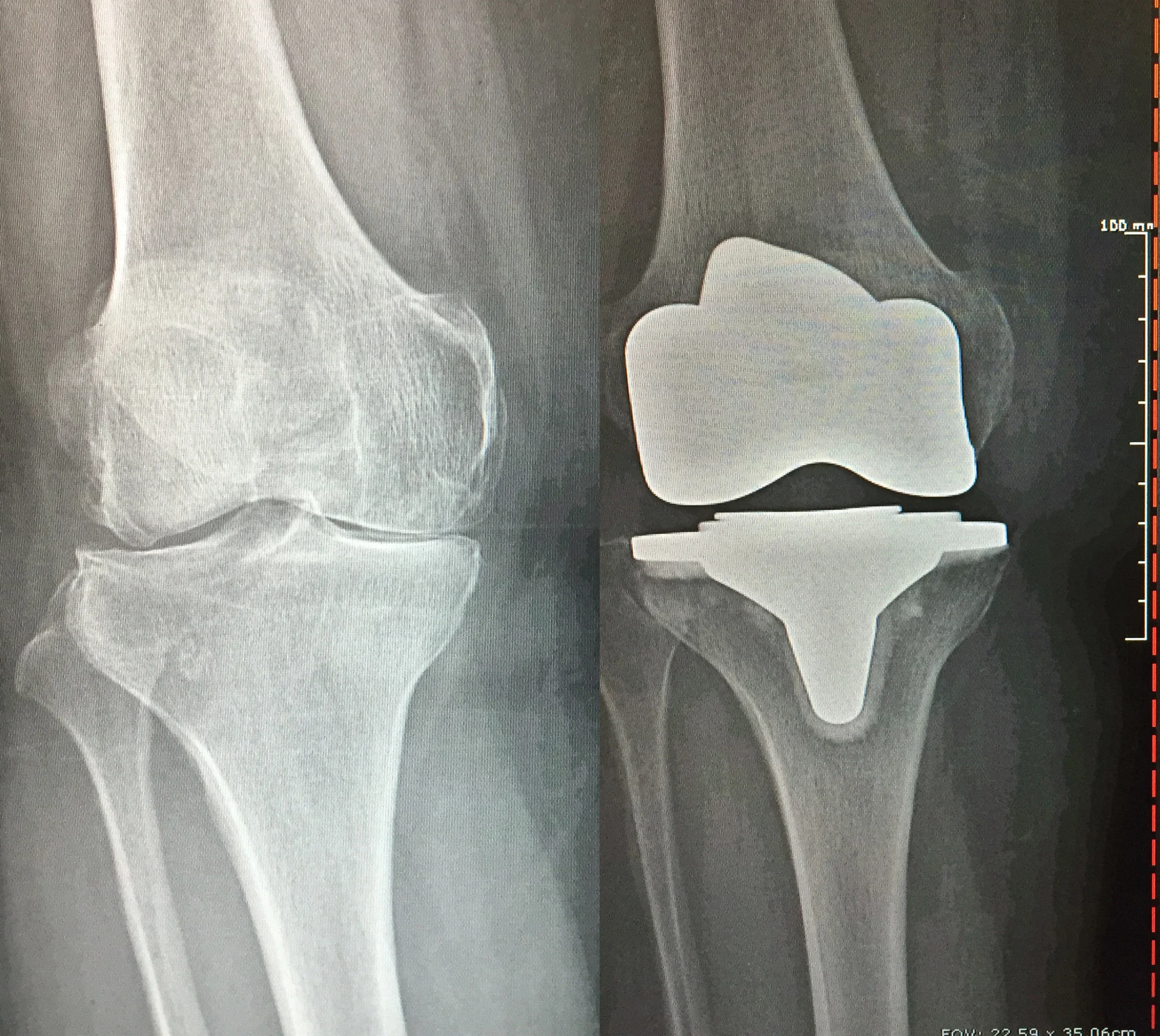 Before: Bone on bone spursAfter: Total Knee Replacement on 59 y/o femaleDEPUY
