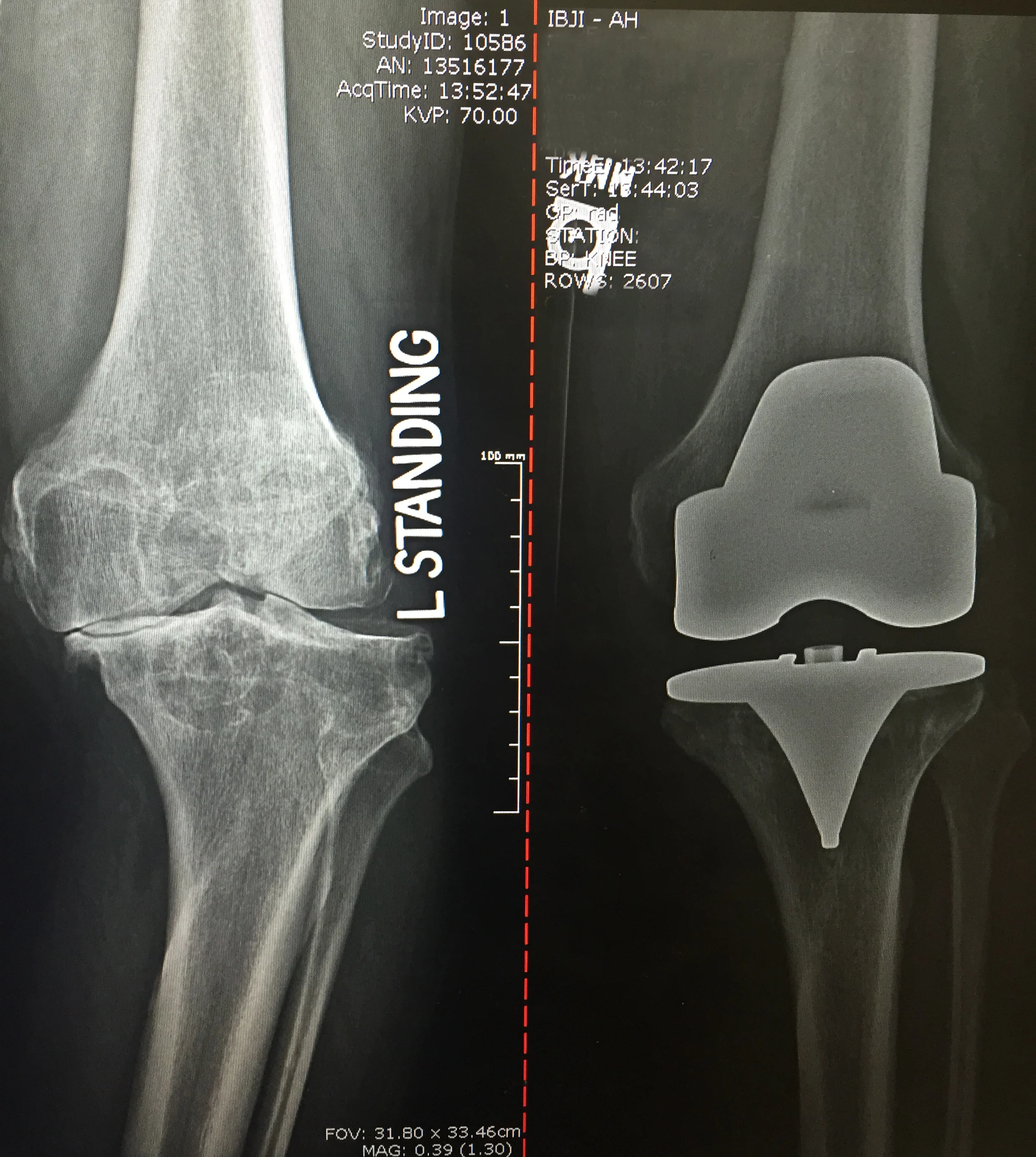 Before: bone on bone - bowedAfter: Total Knee Replacement - straightOMNI