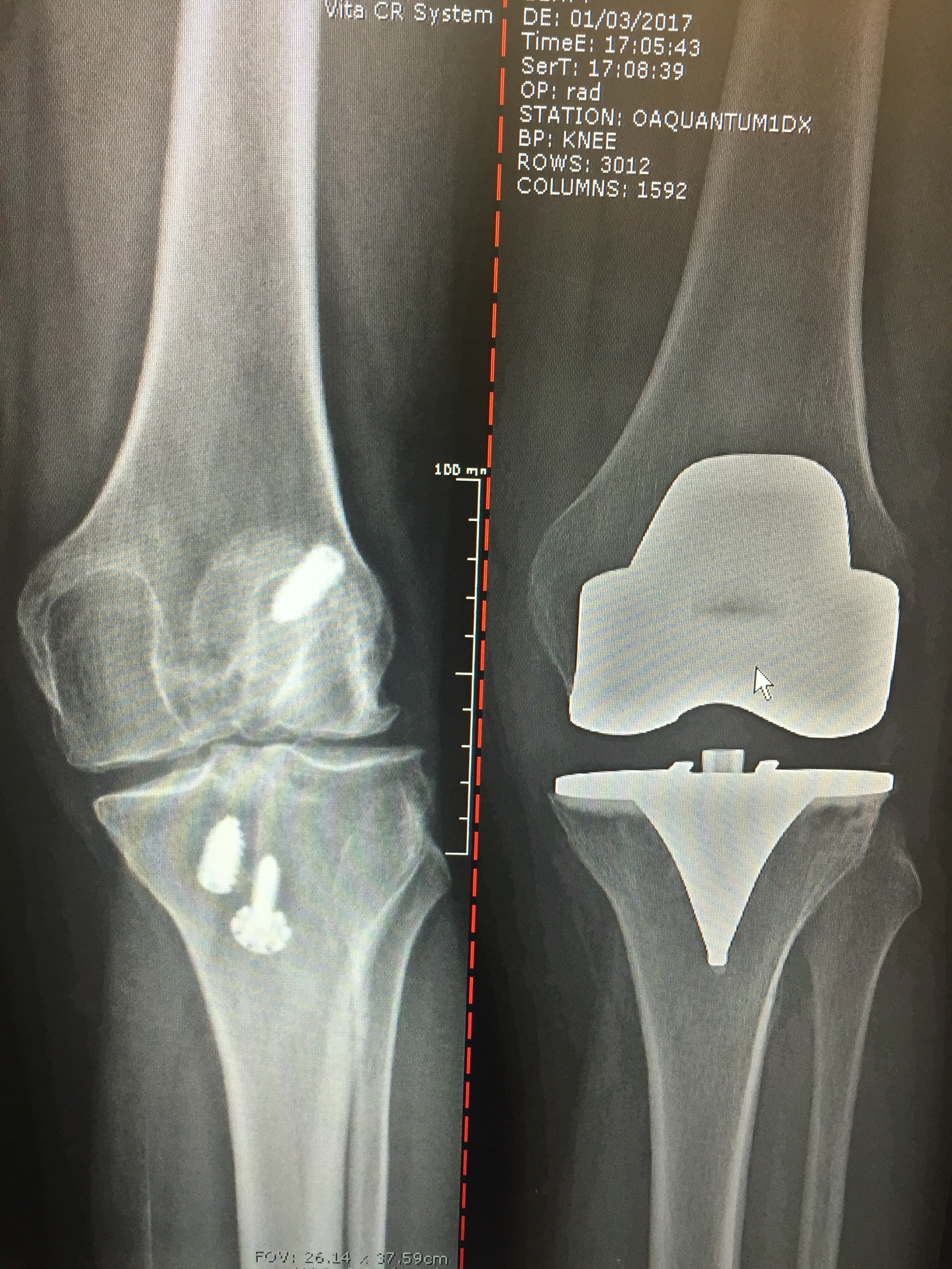 Before: Previous Ligament surgeryAfter: Total Knee Replacement on 45 y/o femaleOMNI