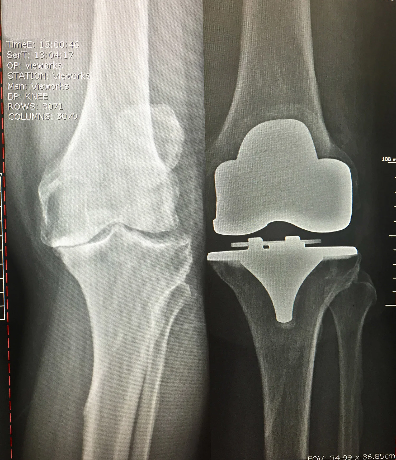 Before: Bone on bone knee arthritisAfter: Total Knee ReplacementBIOMET
