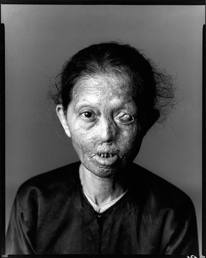 Richard Avedon, Napalm Victim, Saigon 1971