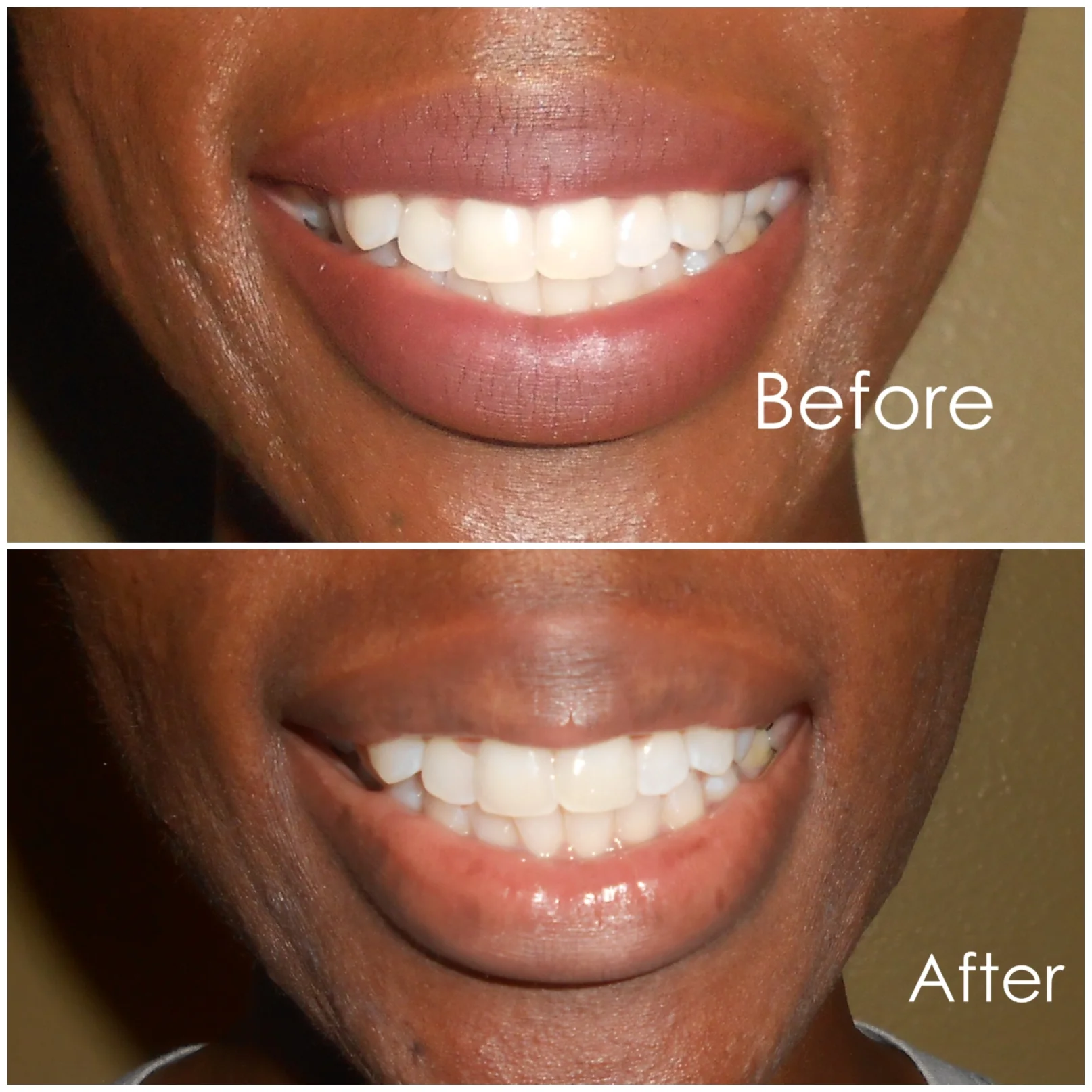 Here are my results!!! For me I already had kind of white teeth, but the whitening system made my teeth a lot brighter and I think the system is great for maintenance and keeping that Smile Pretty!! All results vary from person to person. No ones teeth are the exact same when it comes to how white in color they are.