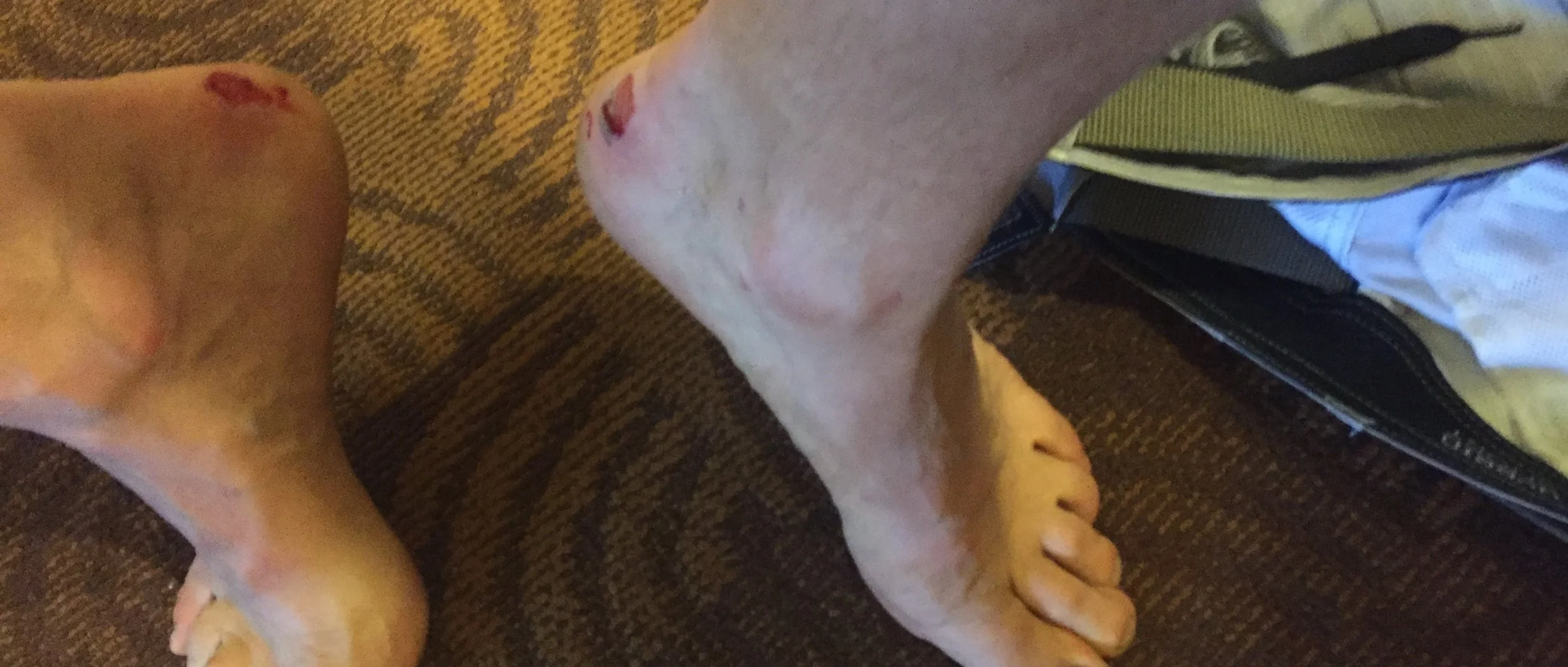 The painful result of wearing the wrong boots.