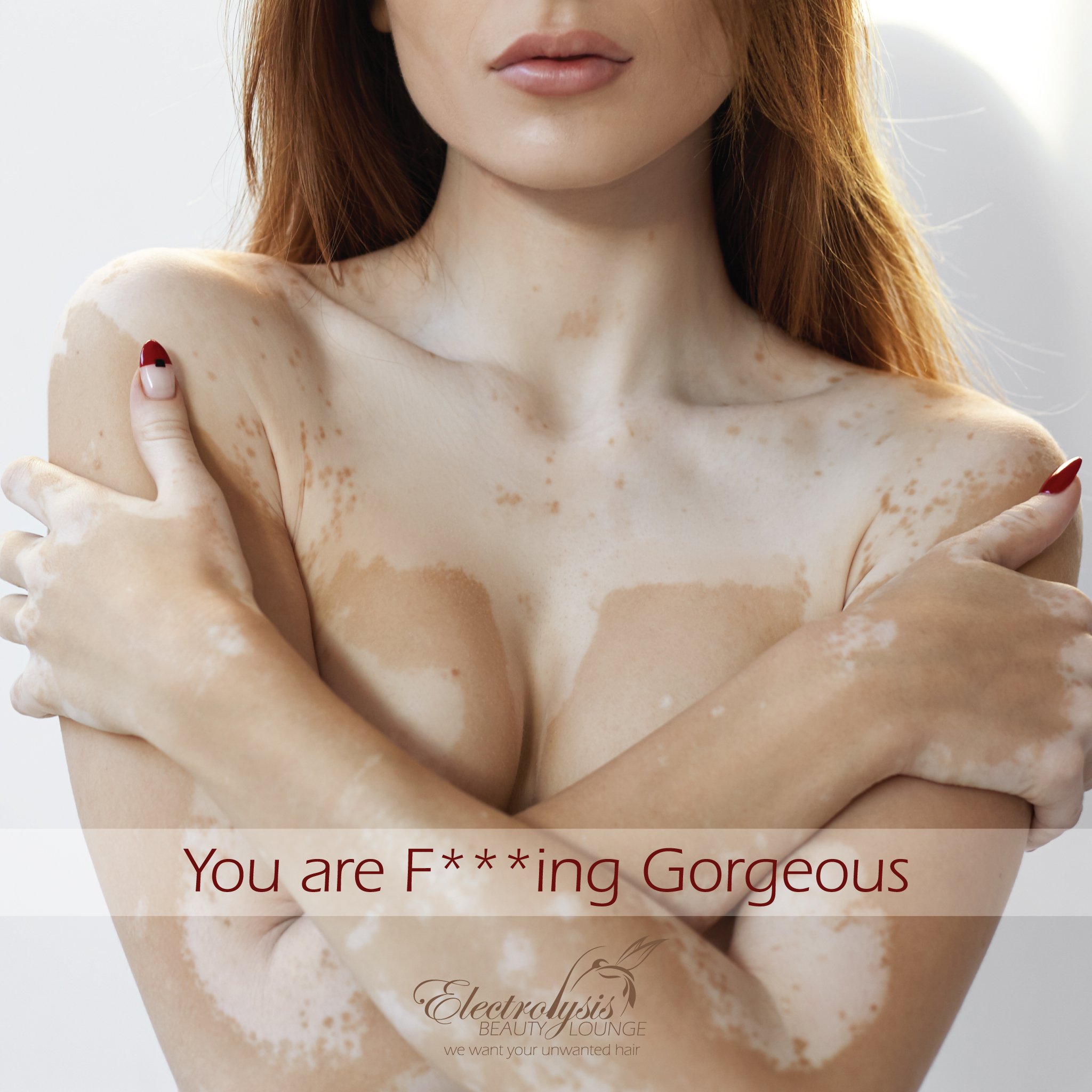 Vitiligo-you-are-effing-gorgeous.jpg