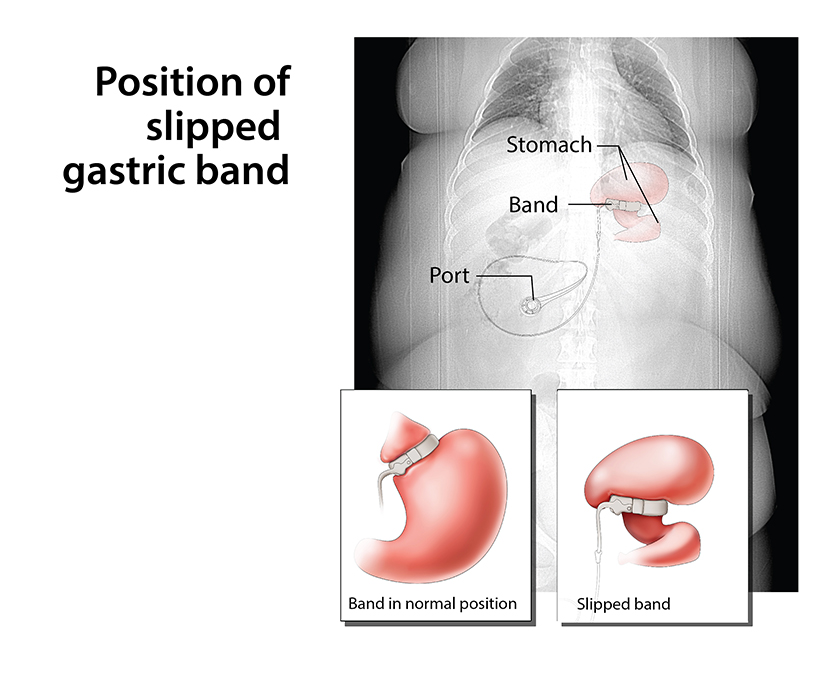 gastric_band.jpg