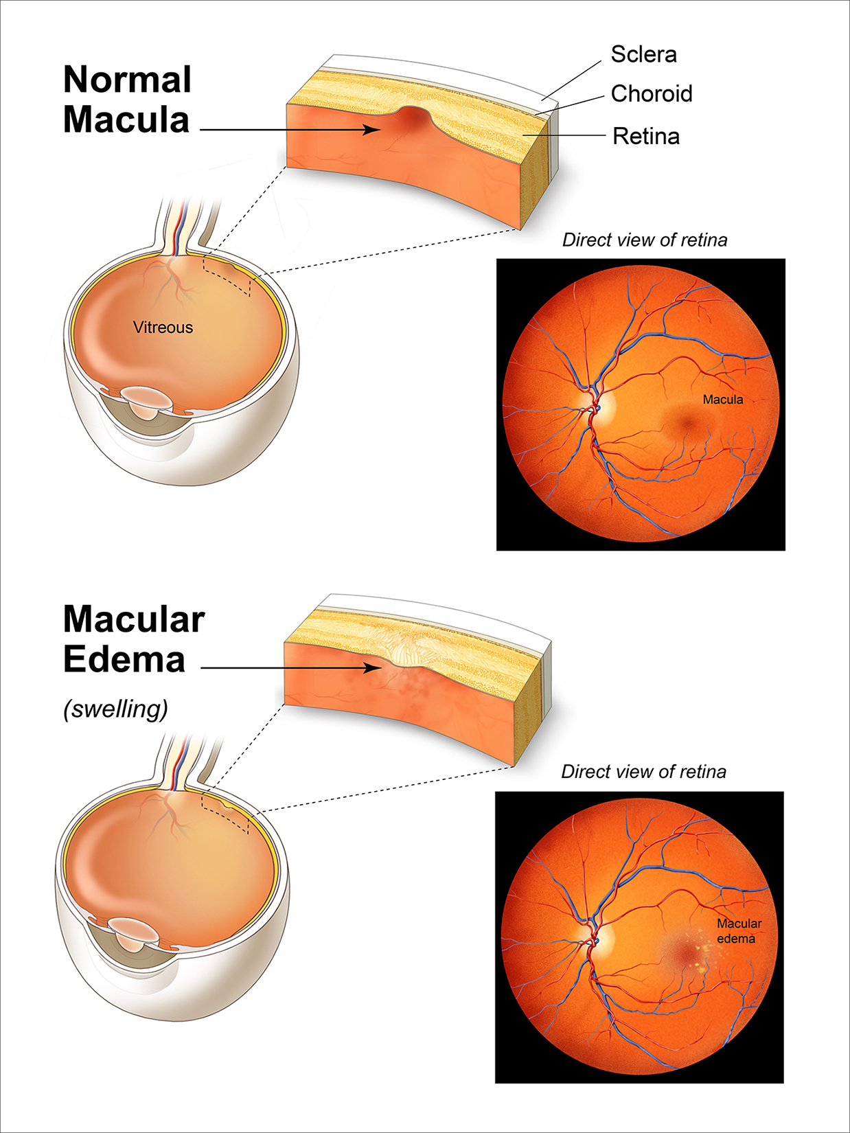 Macular Edema Compared to a Normal Macula