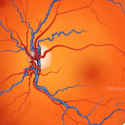 Central Retinal Vein Occlusion (CRVO)