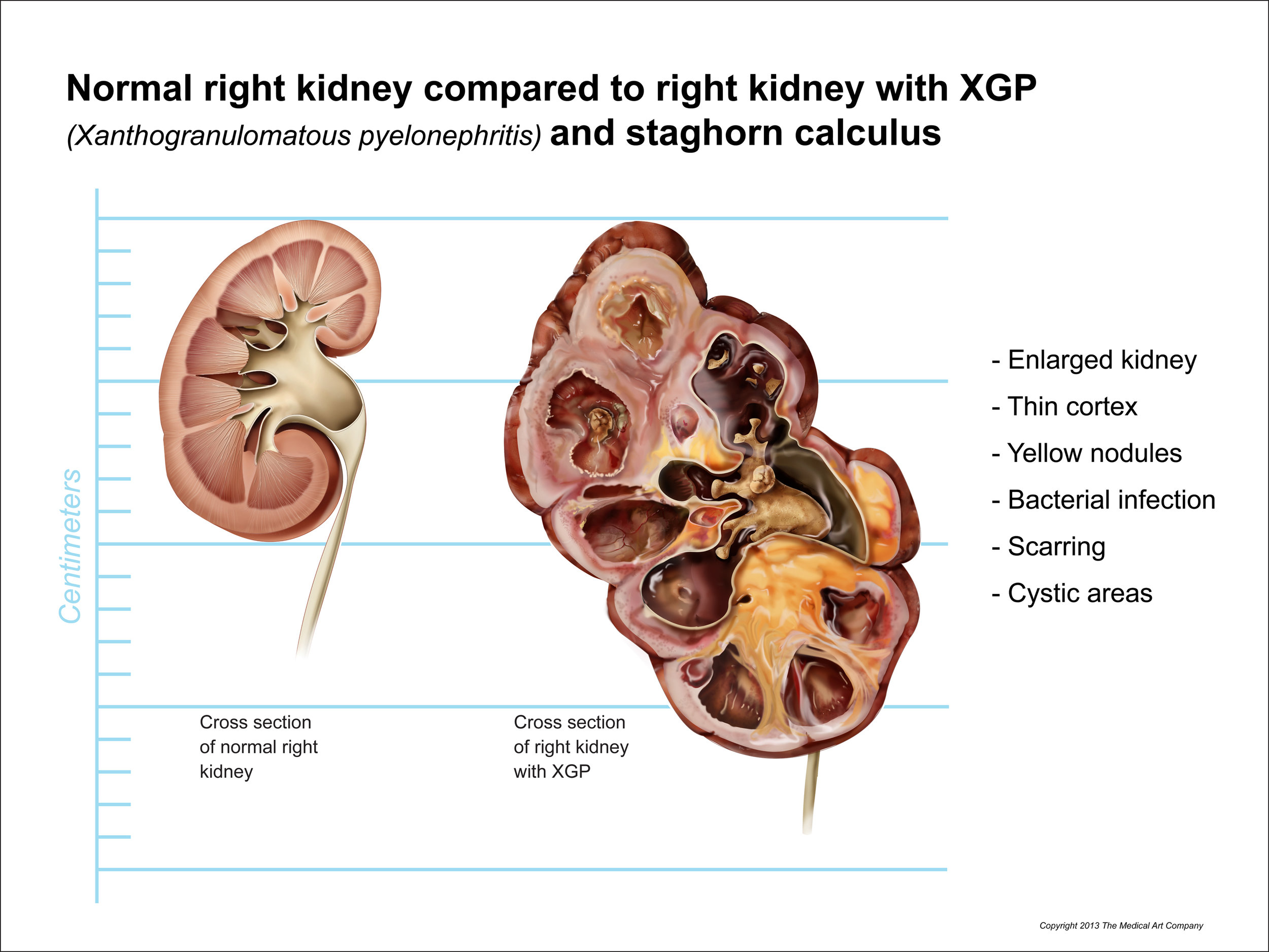 Normal Right Kidney Compared to Right Kidney with Xanthogranulomatous pyelonephritis (XGP)