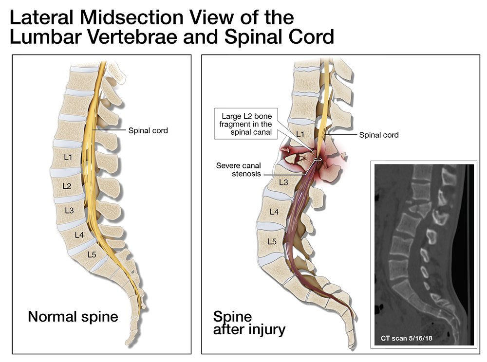 SpinalCord Compression.jpg