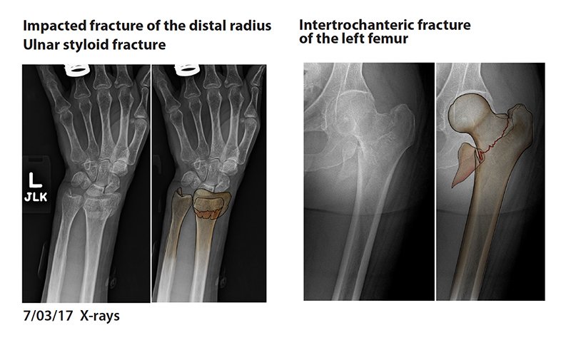 Wrist_HipFractures.jpg