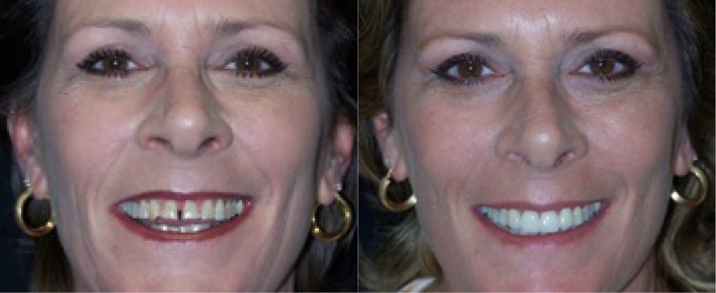 This patient had tooth whitening and 4 porcelain veneers.