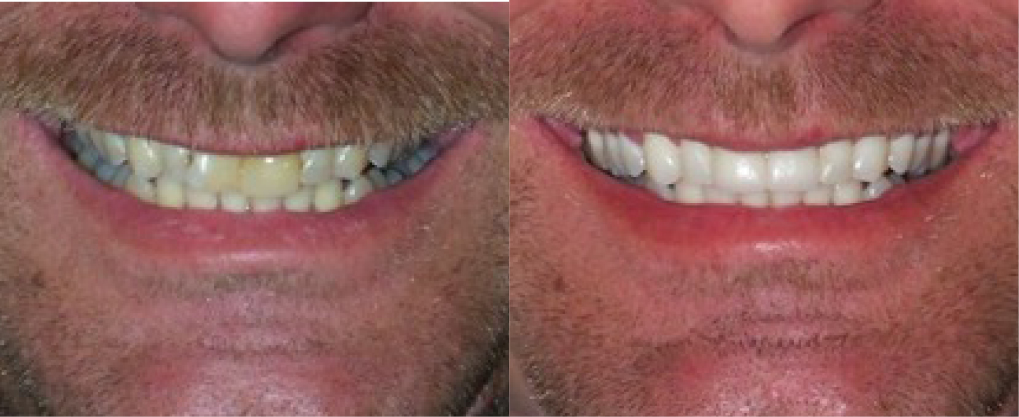 This patient had whitening and 2 crowns.