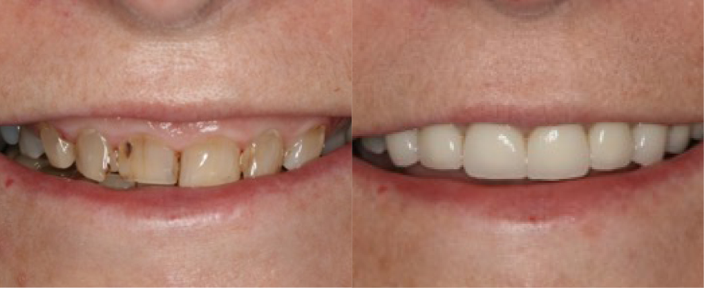 This patient had severely weak and fragile teeth and excessive gum tissue. &nbsp;She was treated with a gum reduction procedure and crowns.