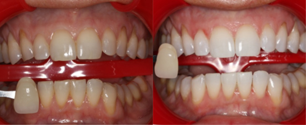 This patient went through our KOR whitening procedure, the best whitening technique available.
