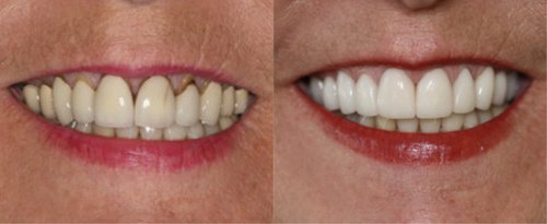 This patient had older crowns with gum recession that looked discolored. She was treated with newer crowns.