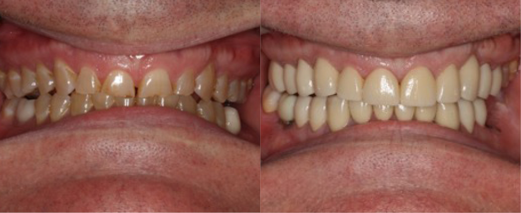 This patient had severe wear . &nbsp;He was treated with full mouth rehabilitation using implants and crowns.